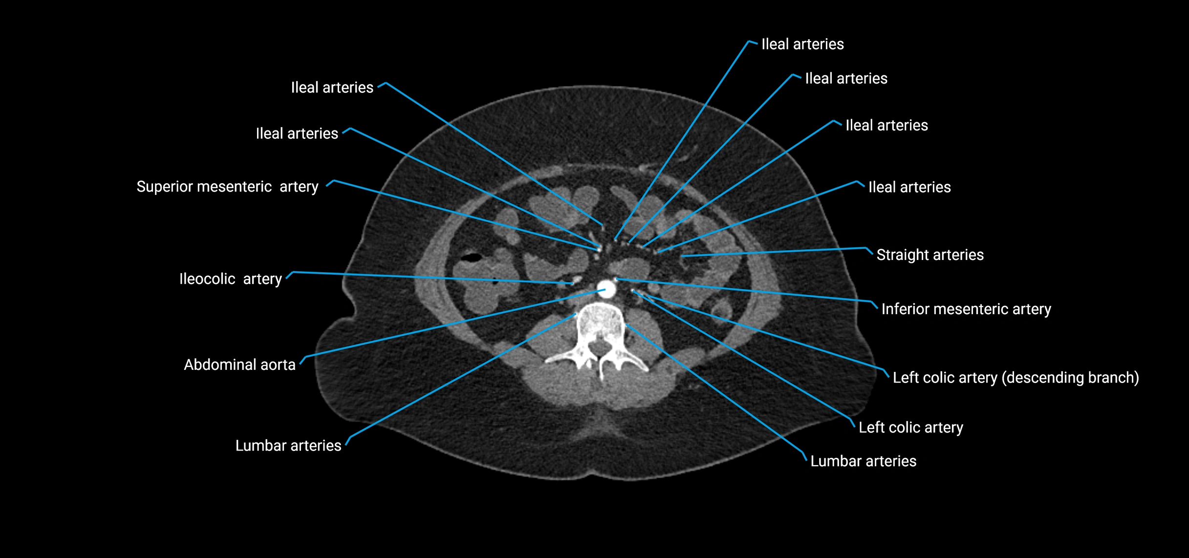CTA abdomen axial cross sectional anatomy labelled image_115 (2).webp
